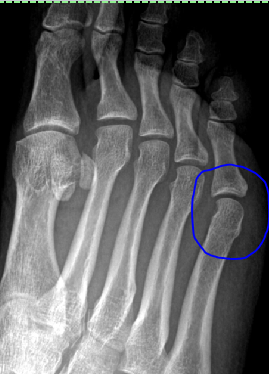 Oh, my achin’ foot